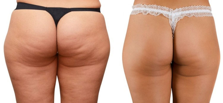 cellulite